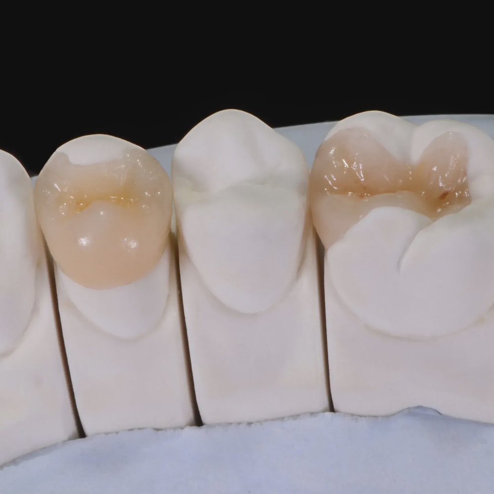 Вкладки керамические